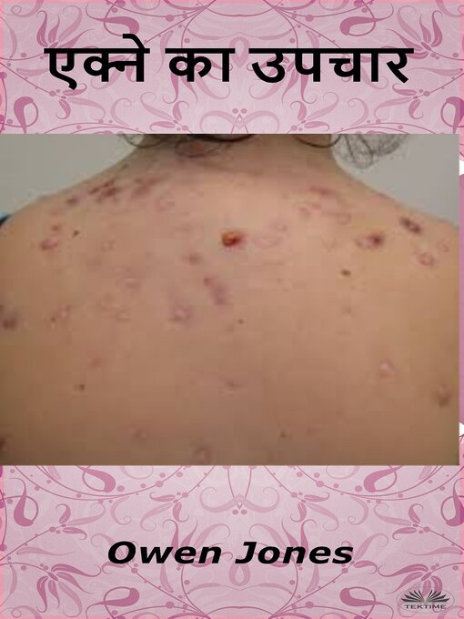 Title details for एक्ने का उपचार‎ by Owen Jones - Available